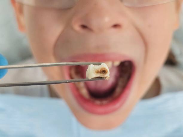 Best Emergency Treatment for Oral Infections in Almont, MI